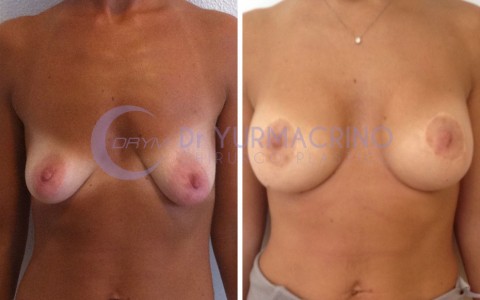 Mastopexy with Implants – Case 7/A