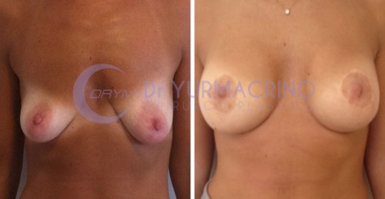 Mastopexy with Implants – Case 7/A