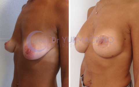 Mastopexy with Implants – Case 7/B