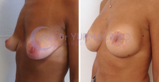 Mastopexy with Implants – Case 7/B