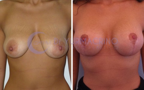 Mastopexy with Implants – Case 8/A