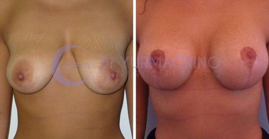 Mastopexy with Implants – Case 8/A