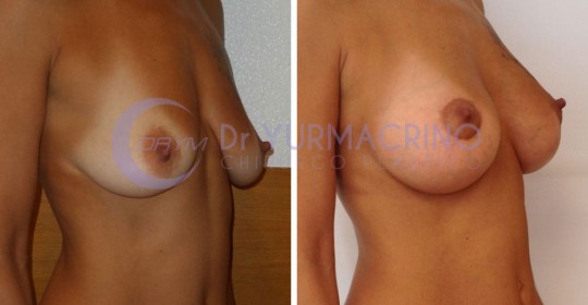 Mastopexy with Implants – Case 9/B