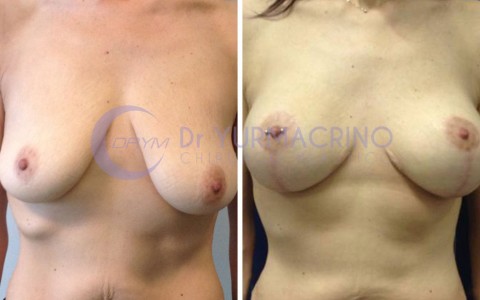 Mastopexy with Implants – Case 10/A