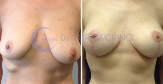 Mastopexy with Implants – Case 10/A