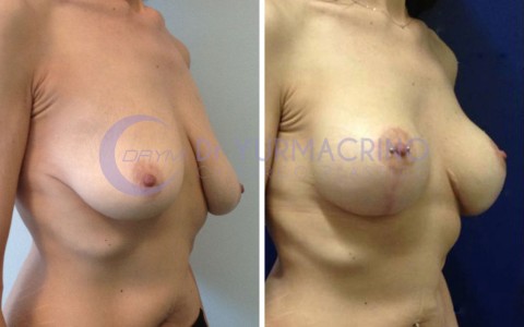 Mastopexy with Implants – Case 10/B