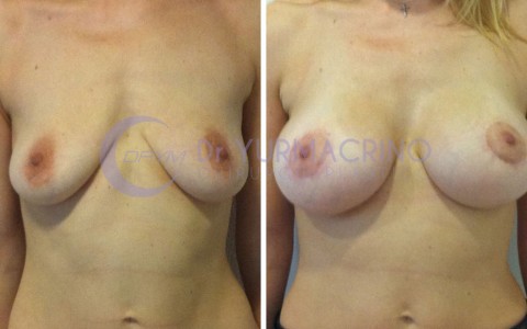 Mastopexy with Implants – Case 11/A