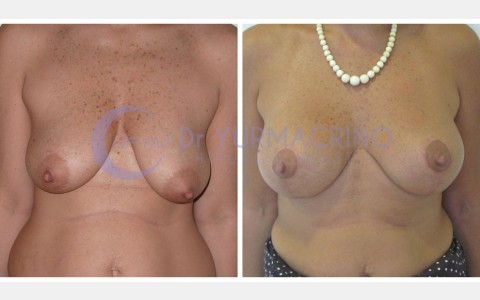 Mastopexy with Implants – Case 12/A