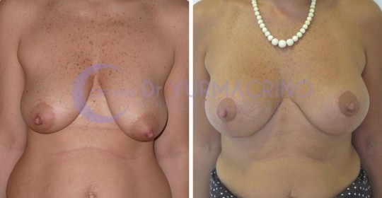 Mastopexy with Implants – Case 12/A