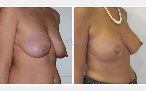 Mastopexy with Implants – Case 12/B