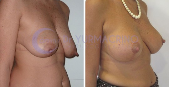 Mastopexy with Implants – Case 12/B