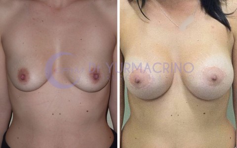 Mastopexy with Implants – Case 13/A