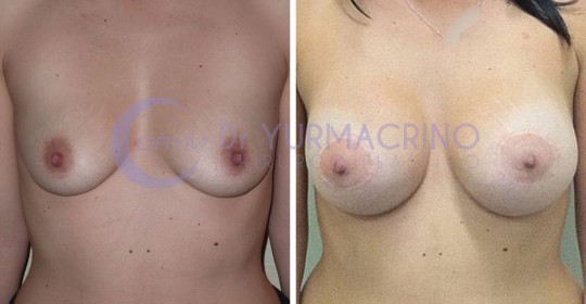 Mastopexy with Implants – Case 13/A