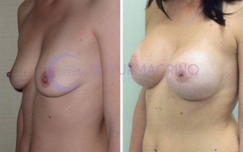 Mastopexy with Implants – Case 13/B