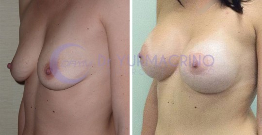 Mastopexy with Implants – Case 13/B