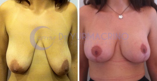 Mastopexy with Implants – Case 14/A