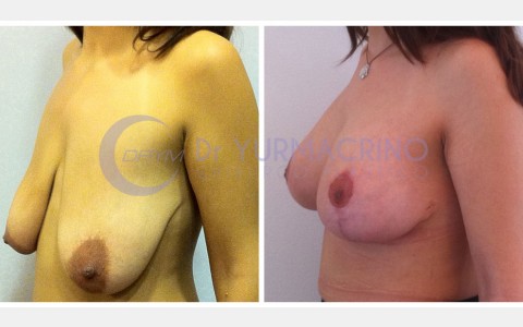 Mastopexy with Implants – Case 14/B