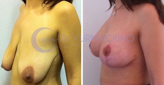 Mastopexy with Implants – Case 14/B