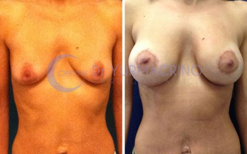 Mastopexy with Implants – Case 15/A
