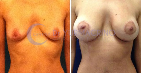 Mastopexy with Implants – Case 15/A