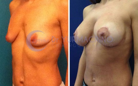 Mastopexy with Implants – Case 15/B