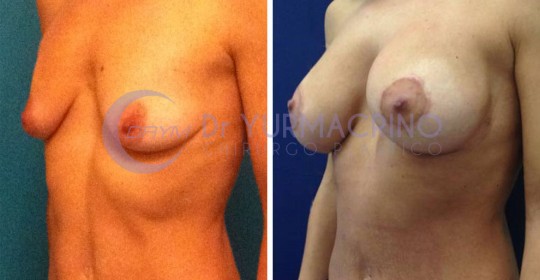 Mastopexy with Implants – Case 15/B