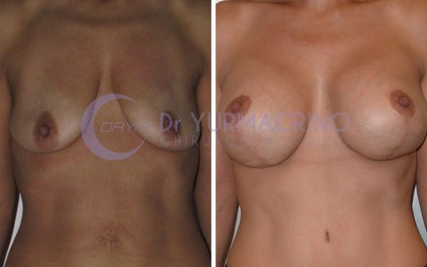 Mastopexy with Implants – Case 16/A