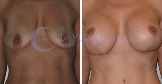 Mastopexy with Implants – Case 16/A