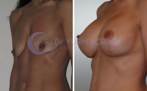 Mastopexy with Implants – Case 16/B