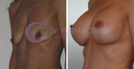 Mastopexy with Implants – Case 16/B