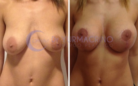 Mastopexy with Implants – Case 17/A
