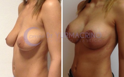 Mastopexy with Implants – Case 17/B