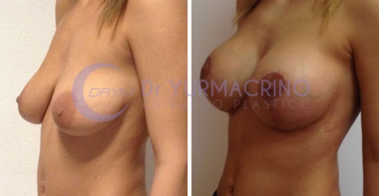 Mastopexy with Implants – Case 17/B