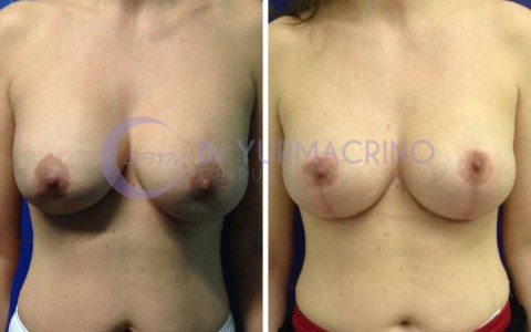 Mastopexy with Implants – Case 18/A