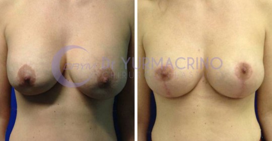 Mastopexy with Implants – Case 18/A