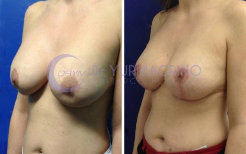 Mastopexy with Implants – Case 18/B