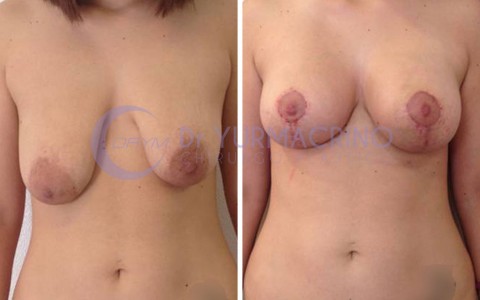 Mastopexy with Implants – Case 19/A