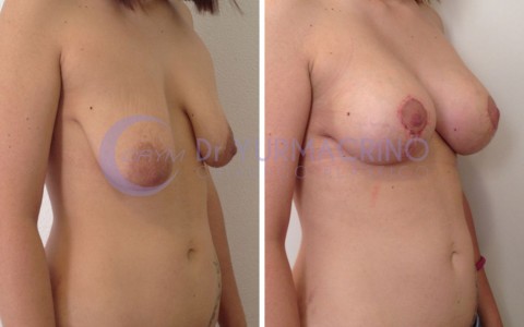 Mastopexy with Implants – Case 19/B