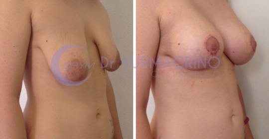 Mastopexy with Implants – Case 19/B