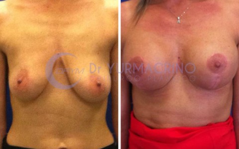 Mastopexy with Implants – Case 20/A