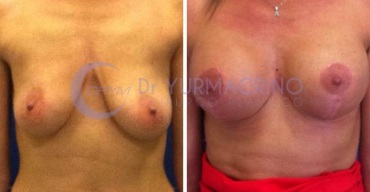 Mastopexy with Implants – Case 20/A