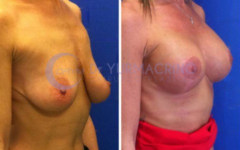 Mastopexy with Implants – Case 20/B