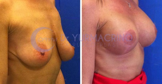 Mastopexy with Implants – Case 20/B