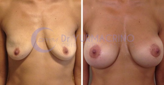 Mastopexy with Implants – Case 21/A