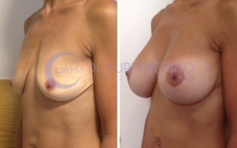 Mastopexy with Implants – Case 21/B