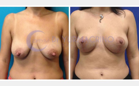 Mastopexy with Implants – Case 22/A