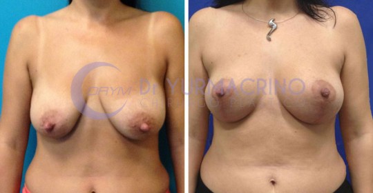 Mastopexy with Implants – Case 22/A
