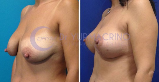 Mastopexy with Implants – Case 22/B