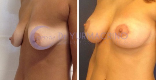 Mastopexy with Implants – Case 23/B