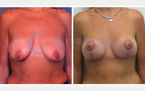 Mastopexy with Implants – Case 24/A